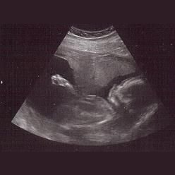 Abortion