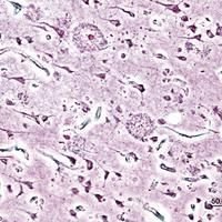 Alzheimer's Disease